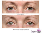 Before and after Thermage eyes 