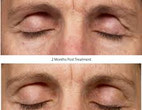 Before and after Thermage eyes 