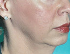 Pre-Treatment Area: Mid/Lower Face & Submentum